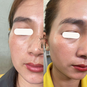 Tại sao nám nội tiết nhiều người đi xử lý mà không đỡ