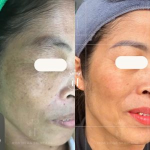 Rất nhiều người xử lý sai với nám hỗn hợp, gây ra nhiều tình trạng khó xử lý hơn ban đầu