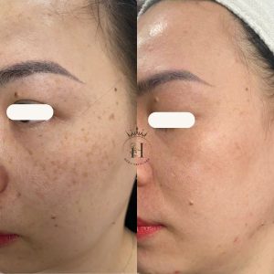 nhiều người nhầm đốm nâu trên mặt là tàn nhang, xử lý sai thông số dẫn đến hậu quả khó lường