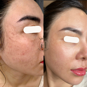 tăng sắc tố là da bạn đang đến gần với sạm da, thâm da