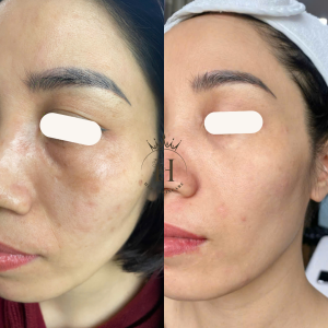 điều gì khiến việc ức chế tyrosinase trở nhanh thành công?