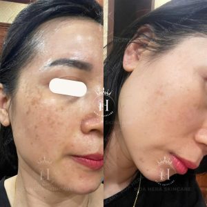 tại sao mà càng chồng nhiều hoạt chất lại càng khiến việc xử lý nám khó hơn