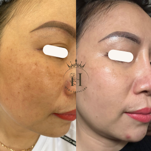 Nóng vội lao cào giảm sắc tố mà quên mất rằng hàng rào bảo vệ da khỏe thì mới đáp ứng được hoạt chất treament mạnh 