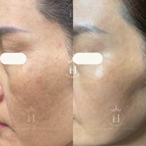 không hẳn việc trị nám 6 tháng vẫn tái lại lỗi là do mỹ phẩm đâu