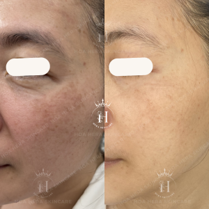 trị nám phải cần thời gian và sự kiên trì