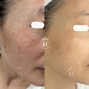 Phân tích sai tình trạng da thì việc bôi serum xử lý nám càng kém hiệu quả