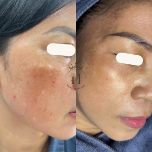 sai lầm khiến da tăng sắc tố đậm hơn khó xử lý hơn