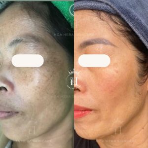 Xử lý nám theo từng cơ địa, tuổi tác của mỗi người khác nhau