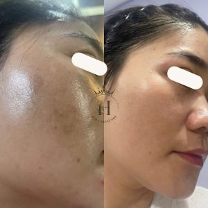 Tình trạng da như: nám chân đinh, nám mảng, nám kem trộn... mỗi 1 tình trạng có 1 phương pháp xử lý nám khác nhau