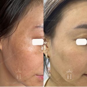 Cấp độ da bạn đang ở mức nào và đáng báo động đỏ cho việc phải phục hồi hàng rào bảo vệ da trước
