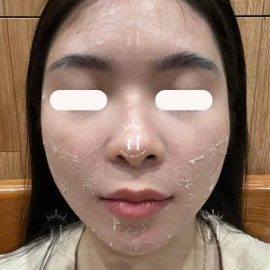 lầm tưởng về chăm sóc da là cứ peel bong tróc mạnh thì da sẽ đẹp