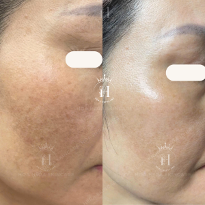 trị nám 6 tháng vẫn tái lại, lỗi là do đâu?