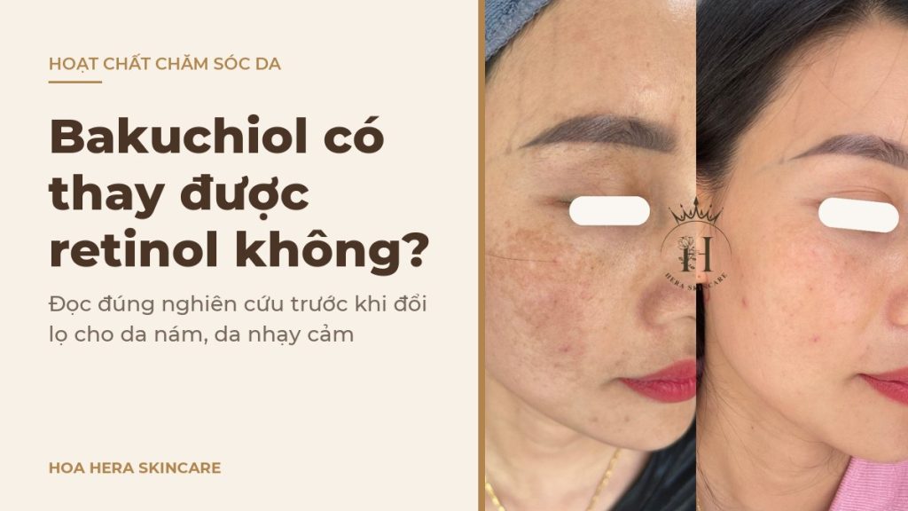 Ảnh bìa bài viết về bakuchiol có thay được retinol không: hình ảnh da vùng má có nám mảng trước và sau một thời gian chăm sóc