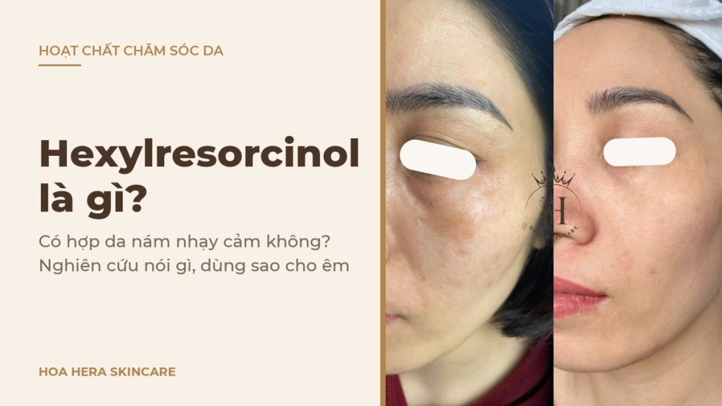Ảnh bìa bài viết về hexylresorcinol là gì: hình ảnh da vùng má có nám má trước và sau một thời gian chăm sóc