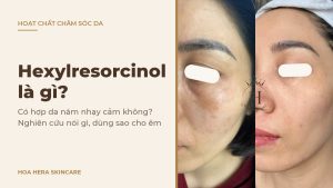 Ảnh bìa bài viết về hexylresorcinol là gì: hình ảnh da vùng má có nám má trước và sau một thời gian chăm sóc