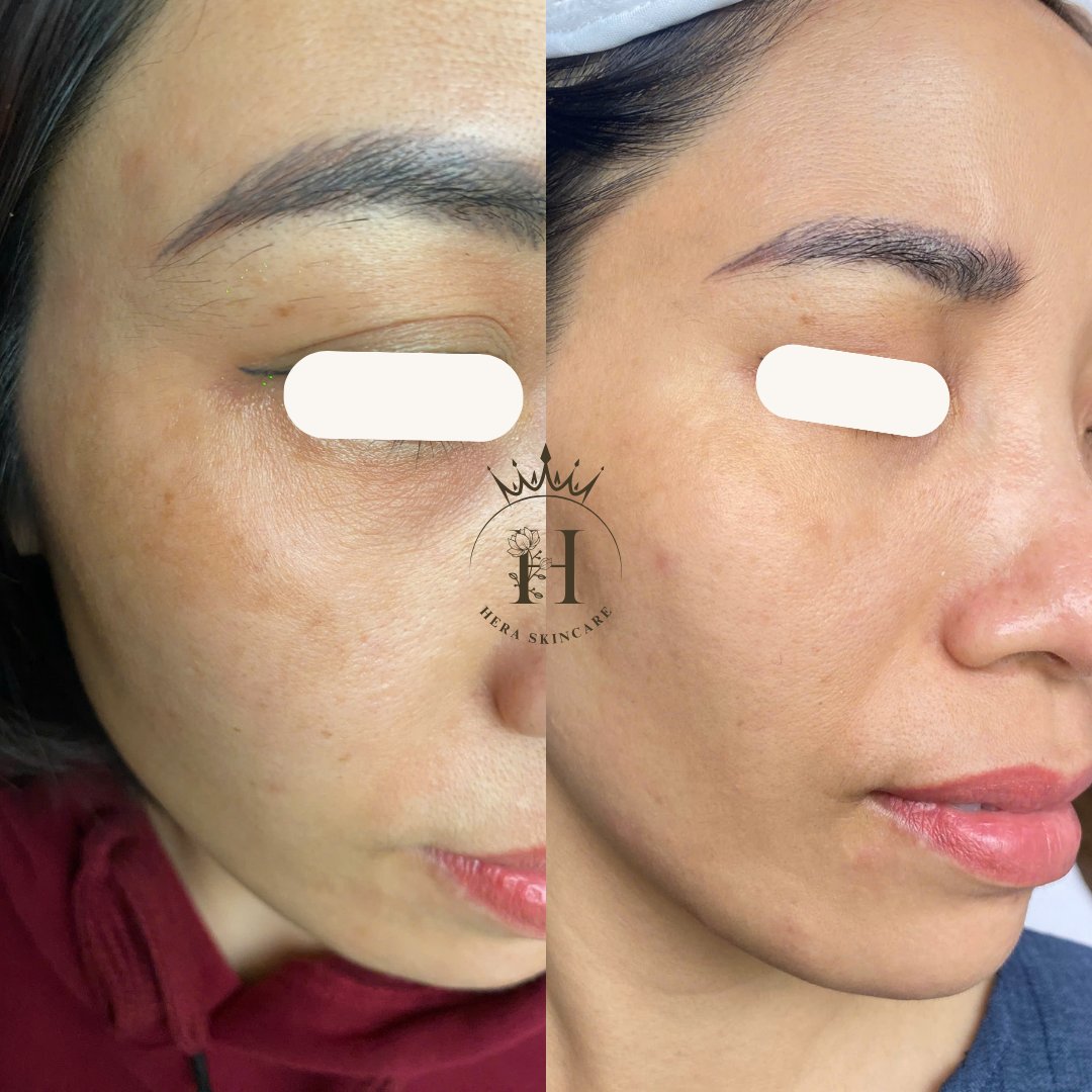 Hình ảnh da vùng má có nám má, so sánh trước và sau một thời gian chăm sóc — minh họa cho chủ đề hexylresorcinol là gì