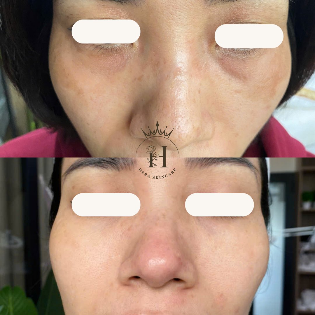 Hình ảnh da vùng má có nám má, so sánh trước và sau một thời gian chăm sóc