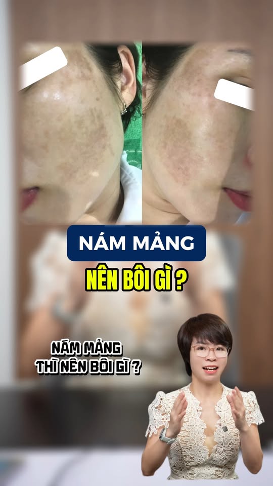 Video: Nám mảng nên bôi gì?