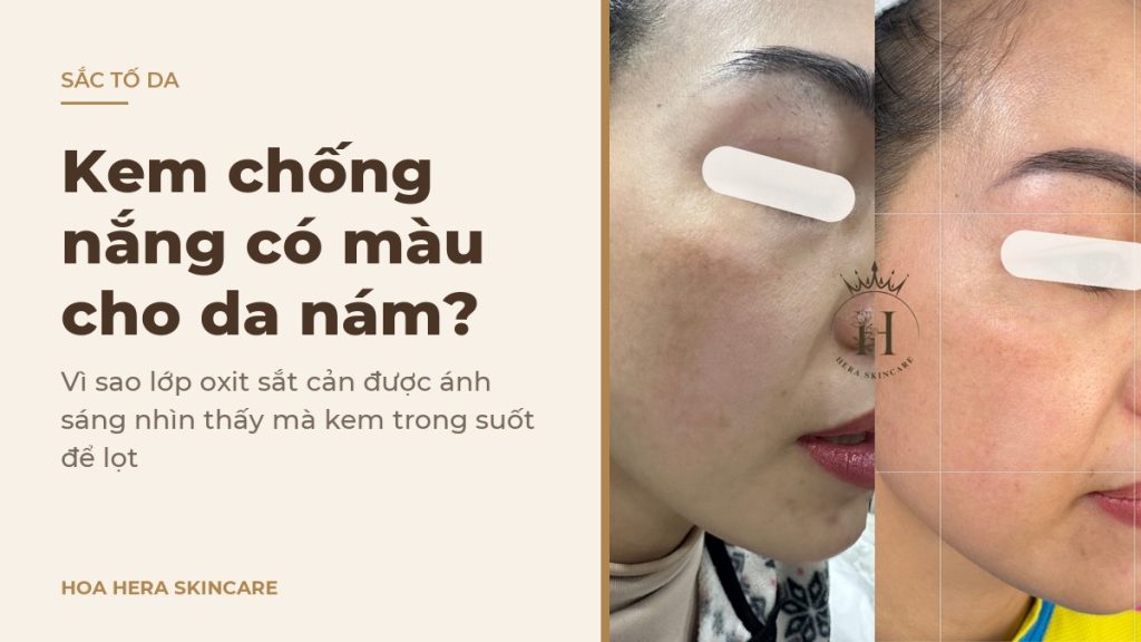 Ảnh bìa bài viết về kem chống nắng có màu cho da nám: hình ảnh da vùng má có nám má trước và sau một thời gian chăm sóc