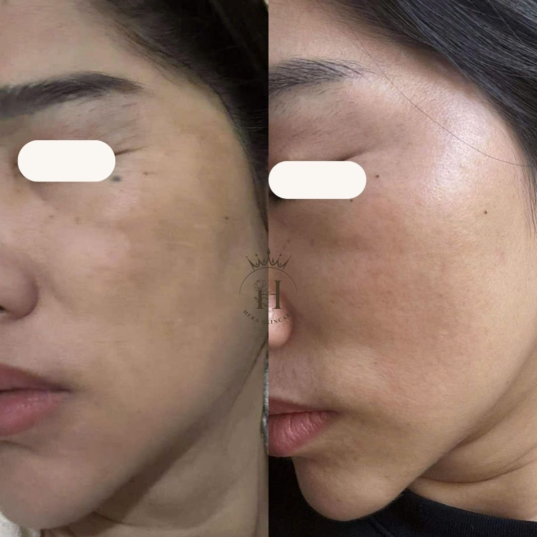Hình ảnh da vùng má có nám má, so sánh trước và sau một thời gian chăm sóc — minh họa cho chủ đề kem chống nắng có màu cho da nám