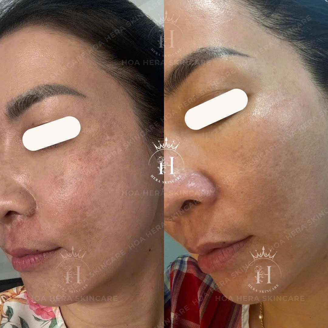 Hình ảnh da vùng má có nám mảng, so sánh trước và sau một thời gian chăm sóc