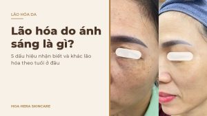 Ảnh bìa bài viết về lão hóa do ánh sáng: hình ảnh da vùng má có nếp nhăn li ti và đốm nâu trước và sau một thời gian chăm sóc