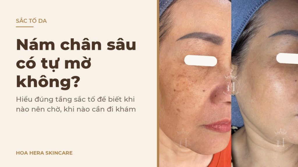 Ảnh bìa bài viết về nám chân sâu có tự mờ không: hình ảnh da vùng má có nám hỗn hợp trước và sau một thời gian chăm sóc