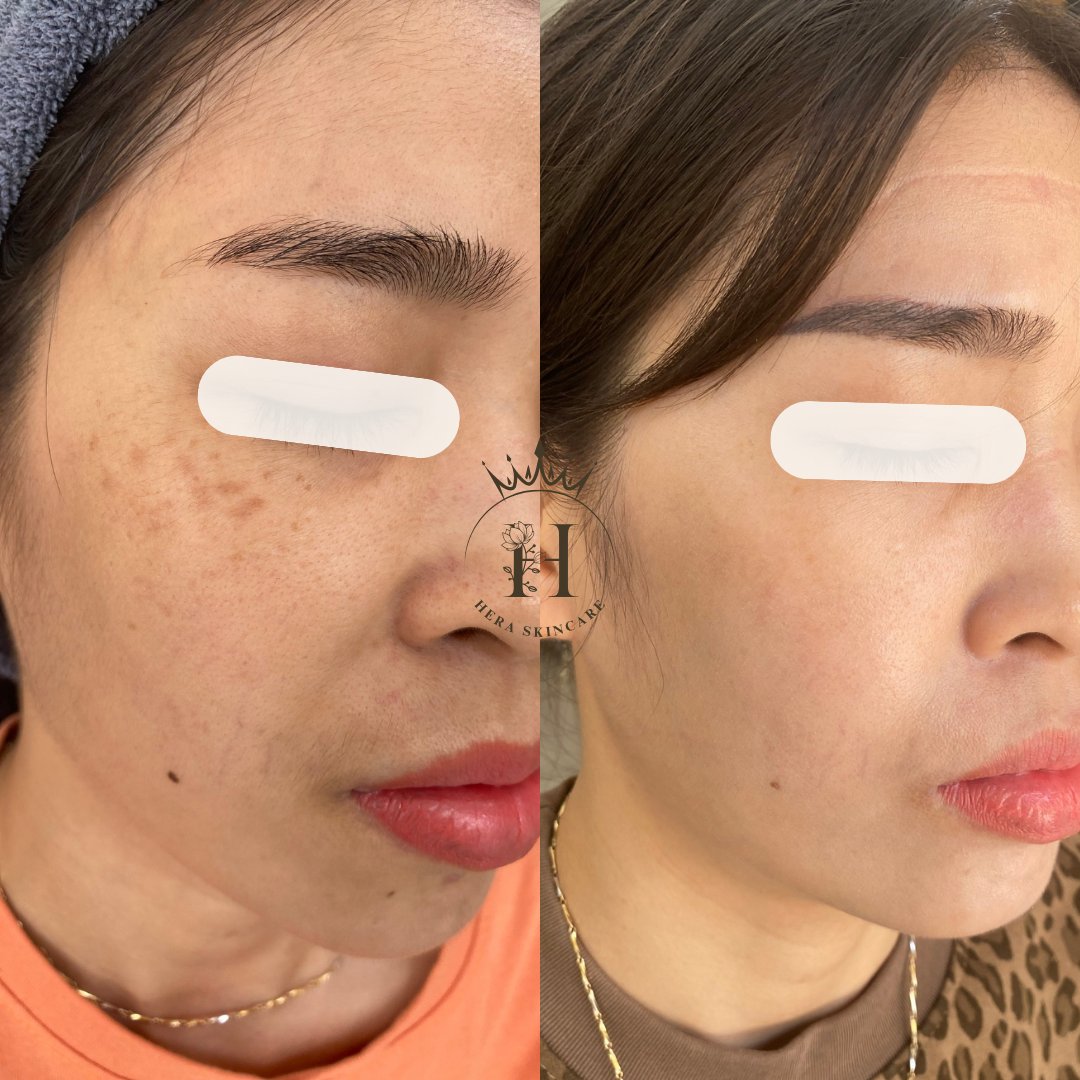 Hình ảnh da vùng má có nám chân sâu, so sánh trước và sau một thời gian chăm sóc