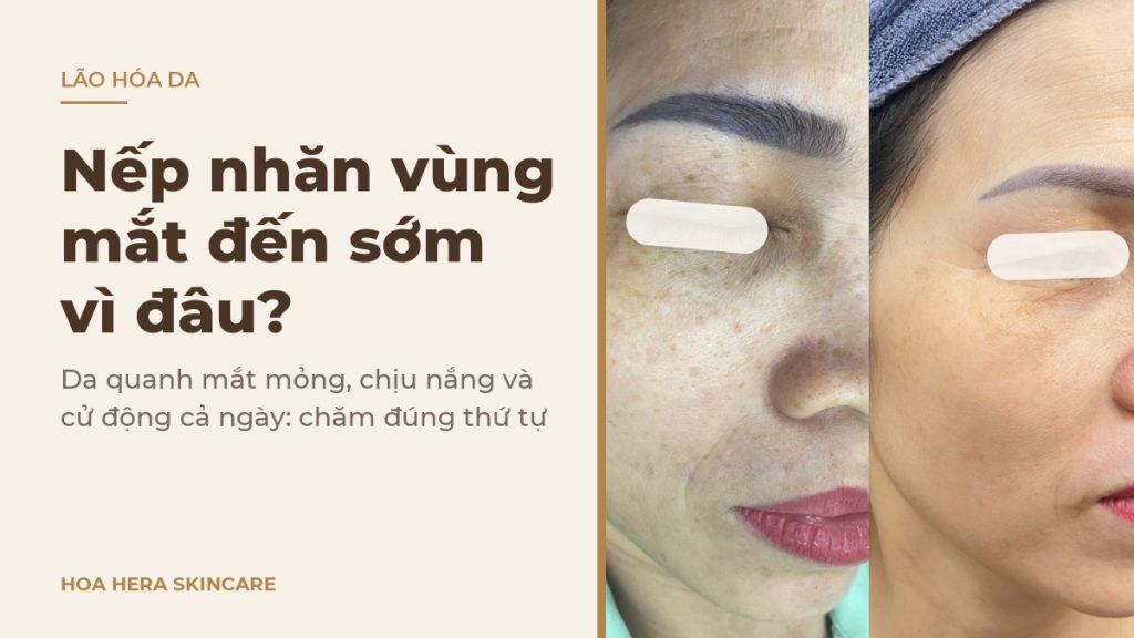 Ảnh bìa bài viết về nếp nhăn vùng mắt: hình ảnh da vùng má có nếp nhăn li ti và đốm nâu trước và sau một thời gian chăm sóc