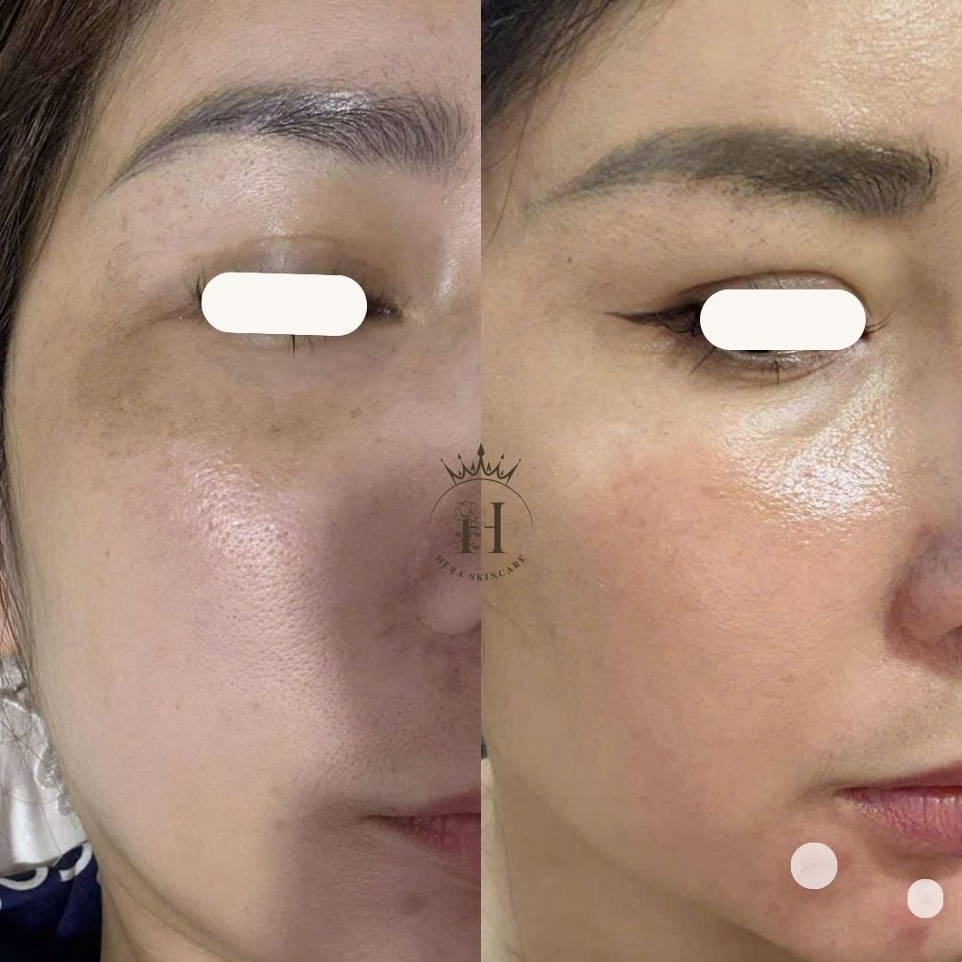 Hình ảnh da vùng má có nám má vùng gần mắt, so sánh trước và sau một thời gian chăm sóc — minh họa cho chủ đề nếp nhăn vùng mắt