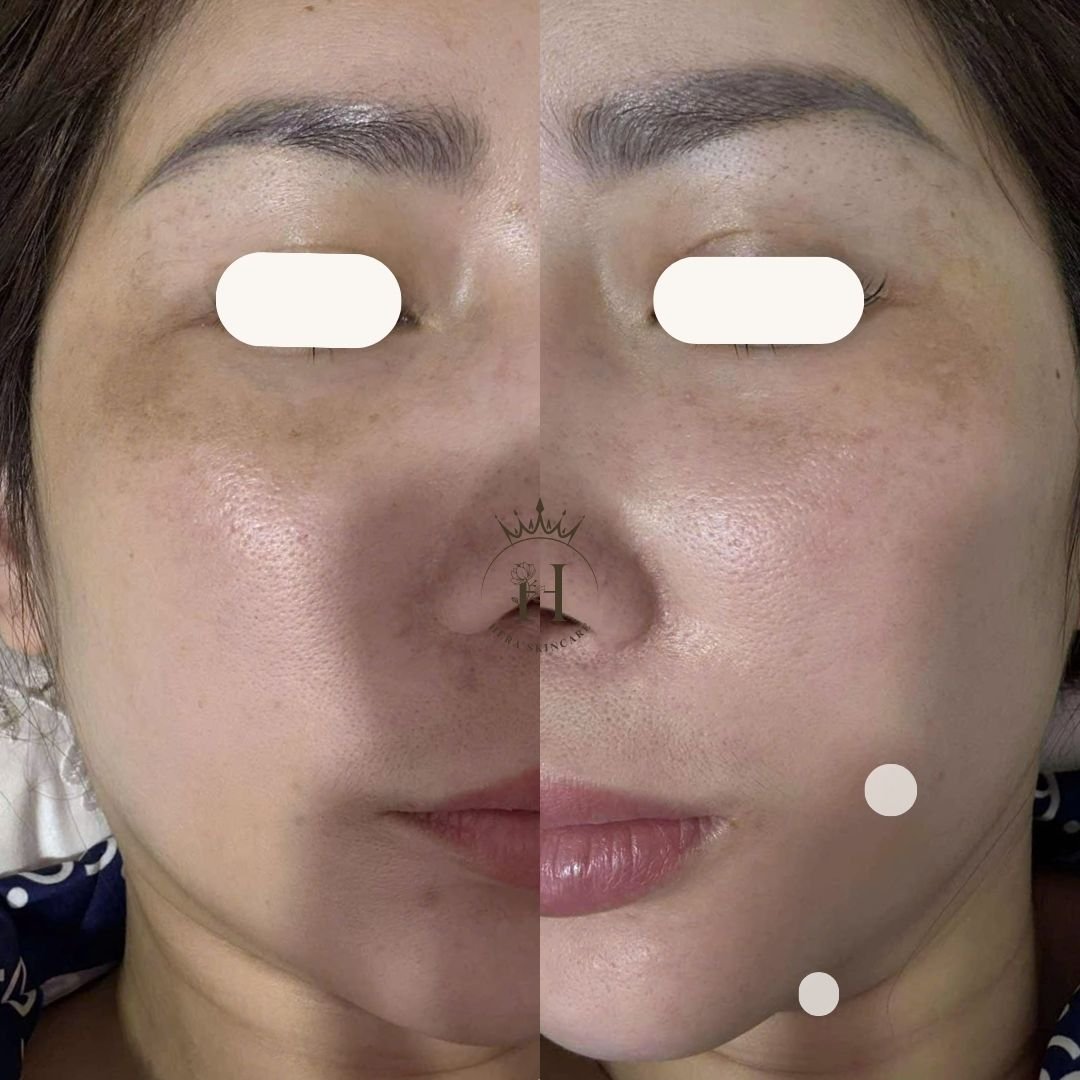 Hình ảnh da vùng má có nám má vùng gần mắt, so sánh trước và sau một thời gian chăm sóc