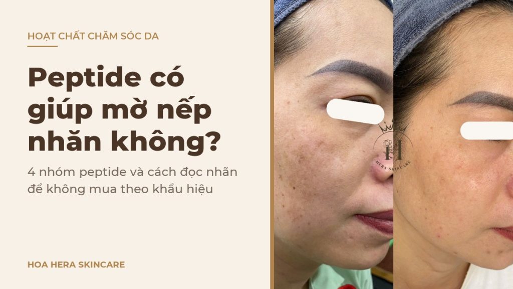 Ảnh bìa bài viết về peptide có giúp mờ nếp nhăn không: hình ảnh da vùng má có nám má trước và sau một thời gian chăm sóc