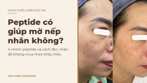 Ảnh bìa bài viết về peptide có giúp mờ nếp nhăn không: hình ảnh da vùng má có nám má trước và sau một thời gian chăm sóc