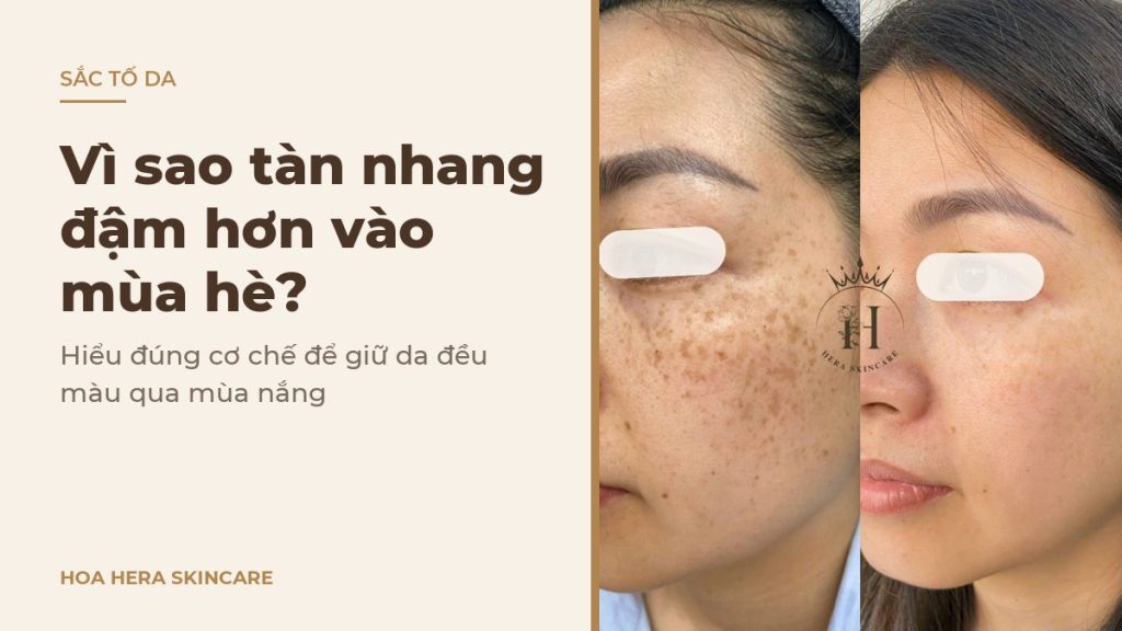 Ảnh bìa bài viết về tàn nhang đậm hơn vào mùa hè: hình ảnh da vùng má có tàn nhang trước và sau một thời gian chăm sóc