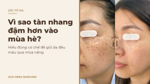Ảnh bìa bài viết về tàn nhang đậm hơn vào mùa hè: hình ảnh da vùng má có tàn nhang trước và sau một thời gian chăm sóc