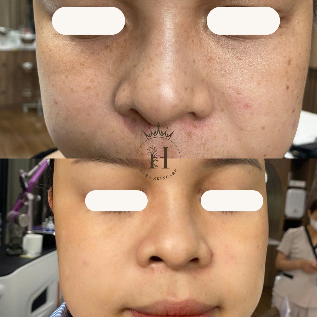 Hình ảnh da vùng má có tàn nhang, so sánh trước và sau một thời gian chăm sóc