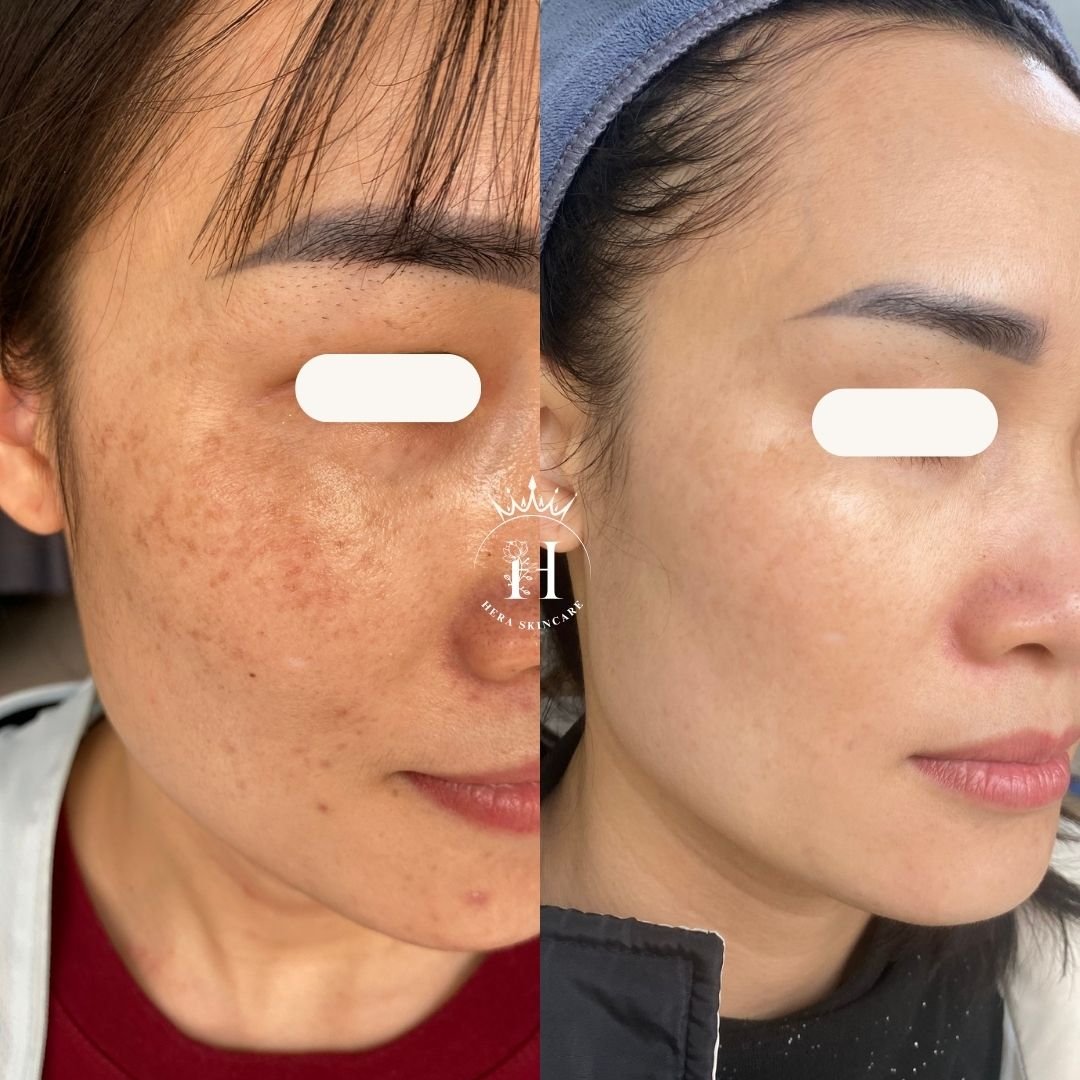 Hình ảnh da vùng má có tàn nhang, so sánh trước và sau một thời gian chăm sóc