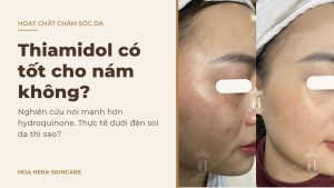 Ảnh bìa bài viết về thiamidol có tốt cho nám không: hình ảnh da vùng má có nám mảng trước và sau một thời gian chăm sóc